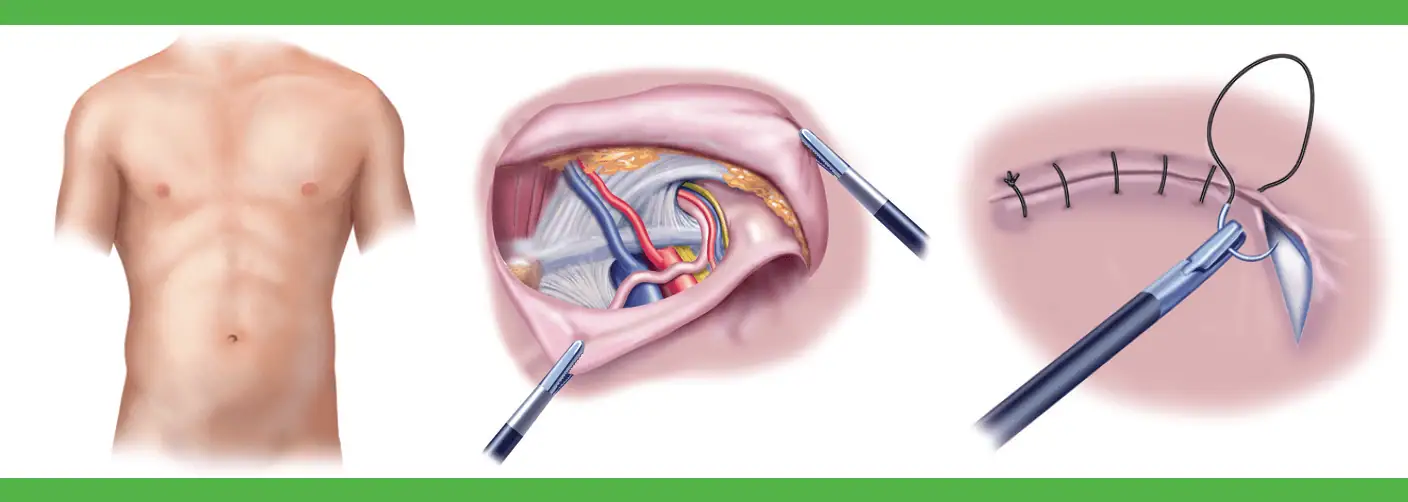 Laparoscopic Inguinal Hernia Repair (TEP) 1