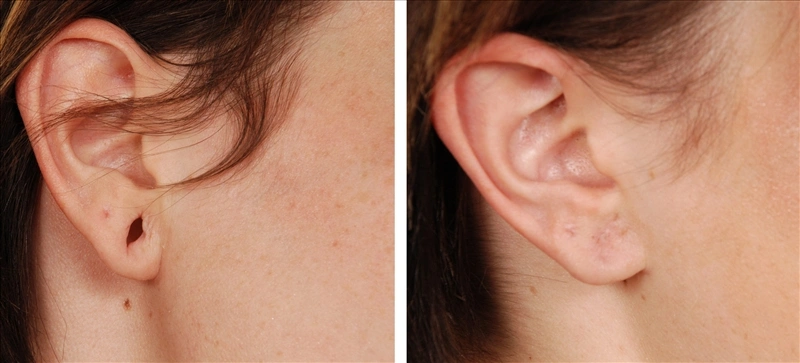 ear-lobe-repair- hyderabad