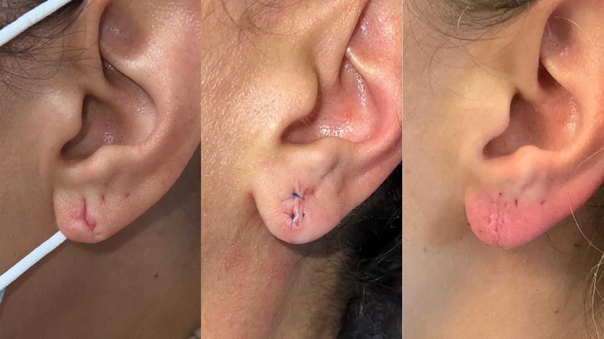 earlobe-repair-june