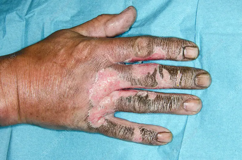 electrical burn