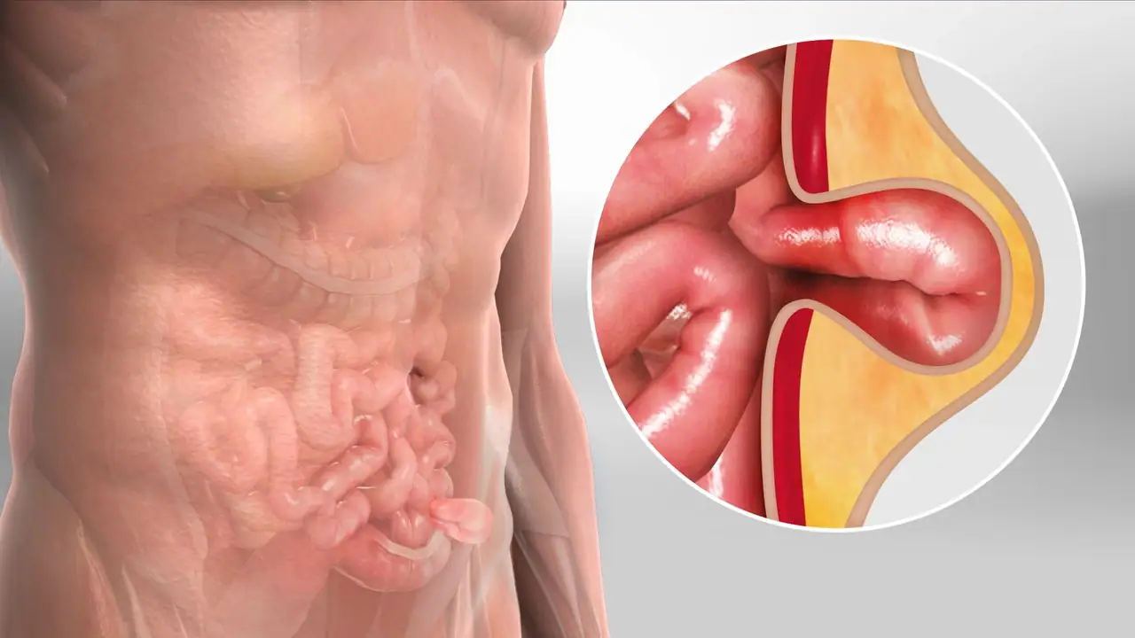 herniasurgerylaparo (1)