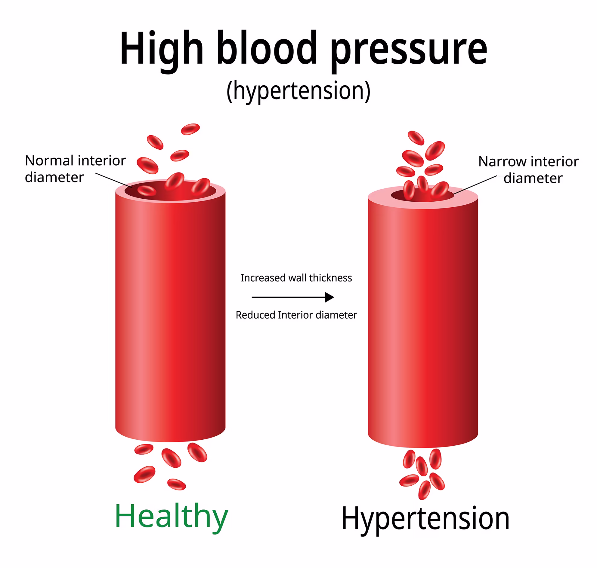 high-blood-pressure-hypertension