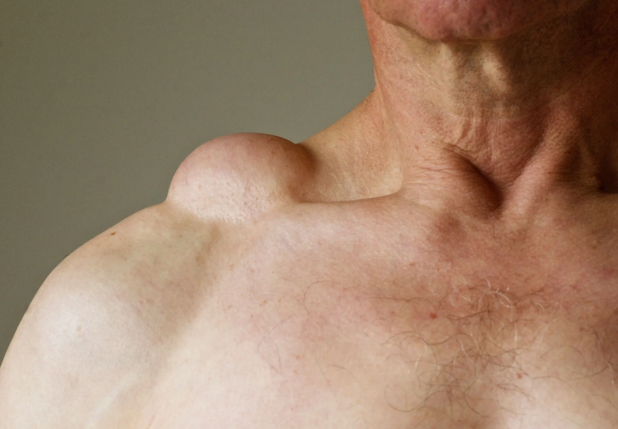 lipoma-9c278c